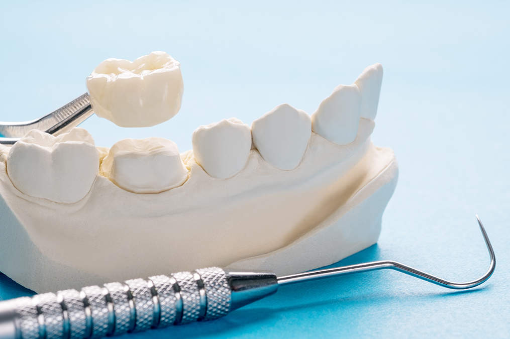 Implantatprothese